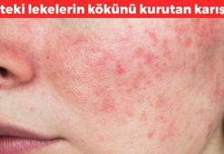 Ciltteki lekeleri vakumluyor! Güneş lekelerini silgi gibi siliyor, izden eser bırakmıyor