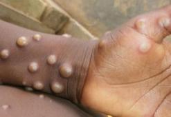 Ankara'da maymun çiçeği karantinası iddiası! İl Sağlık Müdürlüğü'nden açıklama geldi