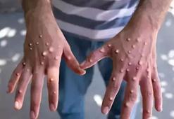 Maymun çiçeği virüsü Türkiye'de var mı? Maymun çiçeği virüsü Türkiye'de görüldü mü, belirtileri nelerdir?