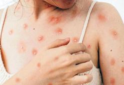 Çiçek aşısı olanlar korumalı