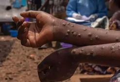 Afrika Birliği uyardı! 'M çiçeği tüm dünyanın sorunu'