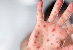 M-Çiçeği virüsüyle zorlu mücadele! Dokuz günlük sancılı süreçte uykusuz geceler: Arkadaşının kaptığı virüsün ne olduğunu bilmiyordu