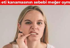 Diş etiniz oluk oluk kanıyorsa sebebi bu olabilir! Meğer eksikliği kanamaya neden oluyormuş: Vücuda girdiği anda vitamin depolarını dolduruyor