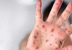 'Maymun çiçeği İstanbul'da görüldü' iddiasıyla ilgili Sağlık Bakanlığı'ndan açıklama