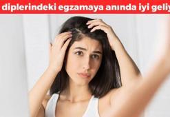Saç diplerindeki egzama ve mantarın kökünü kurutuyor! Gece sürüp sabaha kadar bekletmek yetiyor, kaşıntıdan eser bırakmıyor
