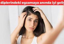 Egzamanın doğal ilacı! Mantar ve egzamaya iyi geliyor, 1 kez kullanmak yeter: Gece sürüp sabaha kadar bekletince kaşıntının kökünü kurutuyor