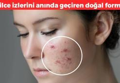Ergenlik sivilcelerini yok ediyor! Nohut tanesi kadar uygulayın, sivilce izinin kökünü kurutuyor