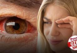Gözde ufak bir kaşıntı ile kendini belli ediyor, mevsim geçişinde vaka sayısı tavan yapıyor! Uzmanı uyardı: Makyaj malzemeleri asıl sebep olabilir!