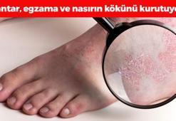 Egzamanın kökünü kurutuyor! Nasır, mantar ve egzamayı tarihe gömüyor, 5 dakikada ayakları pamuk gibi yapıyor!