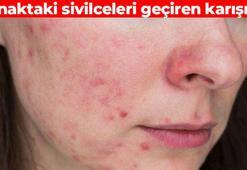 Yanaktaki sivilceleri yok ediyor! Ciltte biriken sebumu söküp atıyor: C vitamini içeriğiyle aydınlatıcı etki veriyor