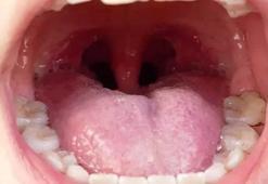 Harvard araştırdı, çareyi buldu! Dil yanığını iyileştiriyor