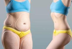 Kadınların gizli düşmanı: Lipödem! ‘Ödem ya da obeziteyle karıştırılmamalı’