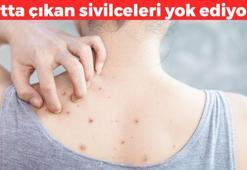 Sırtta çıkan ağrılı sivilceleri yok ediyor! İçi dolu sivilcelerden eser bırakmıyor: Cildi mermerden farksız yapıyor