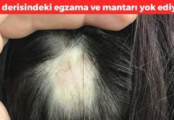 Saç derisindeki egzama ve mantarın kökünü kurutuyor! 1 damla sürmek yetiyor: Kabuk kabuk görüntüyü tarihe karıştırıyor