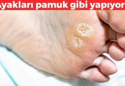 Tek malzemeli nasır kremi! Mantar, nasır ve egzamanın kökünü kurutuyor, ayakları pamuk gibi yapıyor, gece sürünce sabaha kadar etki ediyor
