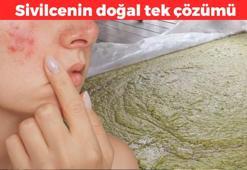 Sivilceleri geçiren tek doğal yöntem! Ciltteki kirleri, yağları ve toksinleri söküp atıyor: Sabahları bir kere uygulamak yeterli oluyor