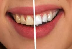 Diş sararması nasıl önlenir? Diş sararmasına iyi gelen şeyler nelerdir?