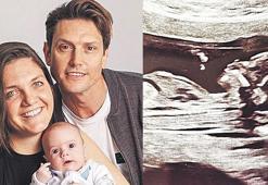 İki kez doğan bebek