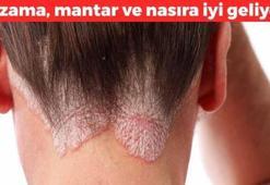 Egzama kremlerine para dökmeyin! Kaşıktı ve kızarıklığı söküp atıyor: Cildi 5 dakikada pamuk gibi yapıyor