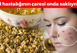 Gül hastalığının en doğal çaresi! Güneş lekelerini ve kızarıklığı silgi gibi siliyor, göz altı morluklarının kökünü kazıyor!