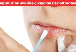 Beyni gizli gizli tehdit ediyor! Dudak kenarında uçuklarınız bu şekilde çıkıyorsa dikkat: Alzheimer riski %80 daha fazla…