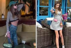 Anoreksiya nevroza nedir? Nihal Candan Anoreksiya nevroza hastası mı oldu, ne demek?