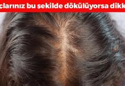 Saçların avuç avuç dökülmesini engelliyor! Sirkeyle karıştırıp sürünce saç köklerine vitamin yükleyip anında ışıl ışıl parlatıyor!