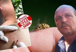 İlk 30 dakika kritik önemde! Uzmanlar belirtilere karşı uyardı: Arı deyip geçmeyin, sadece bir tanesi öldürmeye yetti