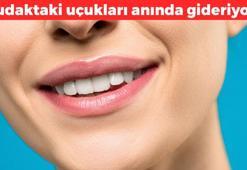 Uçuk çıkınca hemen bu karışımı sürün! Dudakta iz bırakmadan kurutuyor