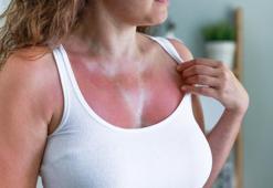 Güneş yanığına ilk müdahaleye dikkat! Dermatologdan hayat kurtaran uyarılar