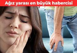 Sürekli ağız yarası oluşuyorsa dikkat! Bu hastalığın en büyük habercisiymiş: Ağız ve göz kuruluğu da belirtileri arasında