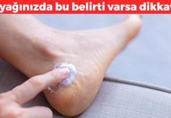 Ayağınızda çatlak varsa dikkat! Kendini topukta gösteriyor: Sinsi sinsi ilerliyor, öldürmüyor ama süründürüyor