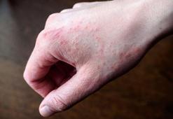 Havuz ve spor salonlarından yayılabiliyor! Ayak ve tırnaklara bulaşıyor: Kaşıntı ve kızarıklığa dikkat