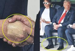 Trump'a damar hastalığı teşhisi