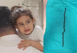 Berfin doktorları şoke etti! 7 ay karnında taşıdı, tam 10 yerinden ameliyat edildi