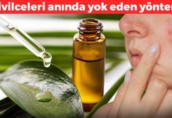 100 yağ bileşeni içeriyor! Sivilceleri anında yok eden yöntem: Kimyasal ürünlerin yüzüne bakmayacaksınız, antibakteriyel etkisi bulunuyor
