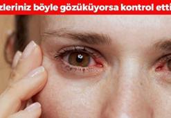Gözyaşının da kalitesi varmış! Bu sebeplere bağlı olarak bozuluyor, yanma ve batma varsa aman dikkat!