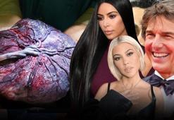 Kardashianlar, Tom Cruise, Blac Chyna... Doğal diye moda olmuştu ama tehlike saçıyor! Uzmanlar uyardı: Zararları çok büyük!