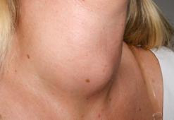 Boynunuzda şişlik varsa aman dikkat, sakın ihmal etmeyin!