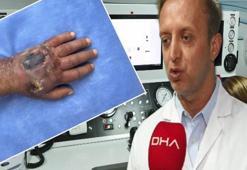 Tıp literatürüne girecek olay! Elini ısıran hırsız yüzünden kolunu kaybediyordu