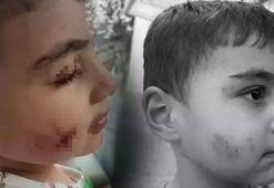 Ankara'da dehşet: Evinde uyuyan çocuğu lağım faresi ısırdı