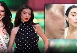 Güzellik kraliçesinin hayatını kararttı! Kozmetik ürünüyle cildine zarar verdi: Ben yaptım siz yapmayın...