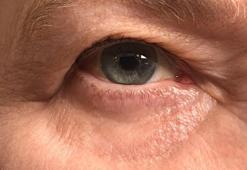 Göz kapaklarında görülen sarkmalar görme güçlüğüne yol açabiliyor