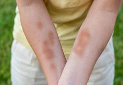 Lyme hastalığı sanılandan daha tehlikeli: Kalıcı ve ağır tablolara yol açabiliyor