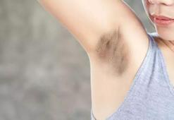 Koltuk altı kararmasına ne iyi gelir, nasıl geçer? Koltuk altı kararmasını geçiren yöntemler?