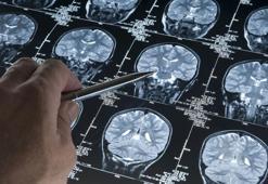 Yapay zeka epilepside çığır açtı! Çocukların beynindeki gizli lezyonları tespit etti