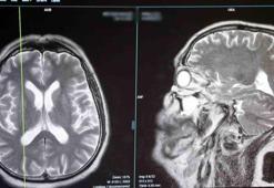 Uzmandan uyarı: Beyin tümörlerinde erken tanı hayat kurtarıyor