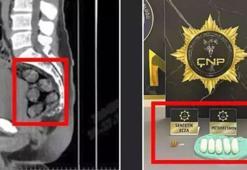 Tomografide şoke eden görüntü! Uyuşturucuyu midesinde saklamış