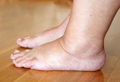 Uzmandan uyarı: “Ödem sadece tuzdan kaynaklanmaz!”