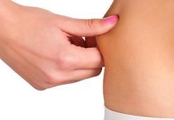 Lipödem kader değil! Diyet ve egzersizle durdurmak mümkün